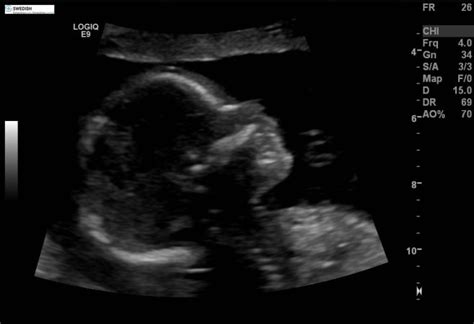 that especially thickened NF in second trimester is the most important soft marker in the detection of Down syndrome among fetuses who have had normal first trimester sonographic screening for. . Soft markers for down syndrome in 20 week ultrasound